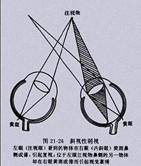 弱视治疗是一个什么样的内在过程呢？（二）