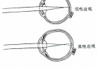 调节痉挛 有些弱视患者康复的最大绊脚石