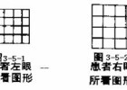 弱视合并散光性屈光参差 治疗后期别大意